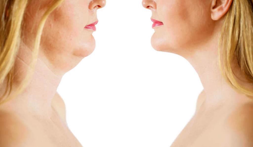 Double Chin treatment Lower Place before and after results