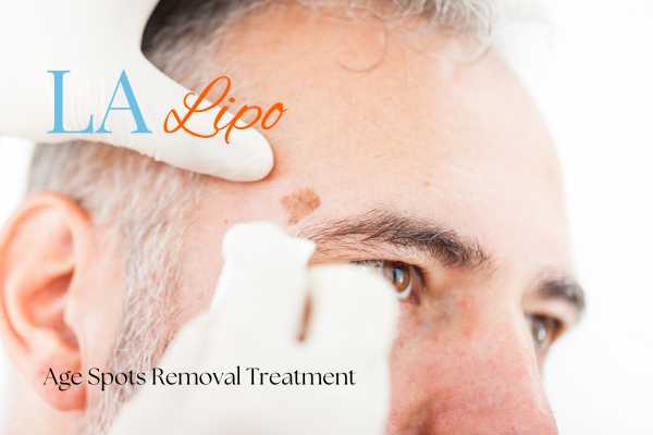 What Are the Most Effective Treatments for Age Spots Lower Place?