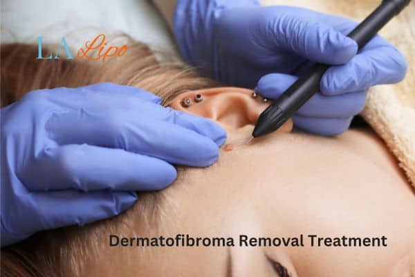 Dermatofibroma Removal Treatment Lower Place