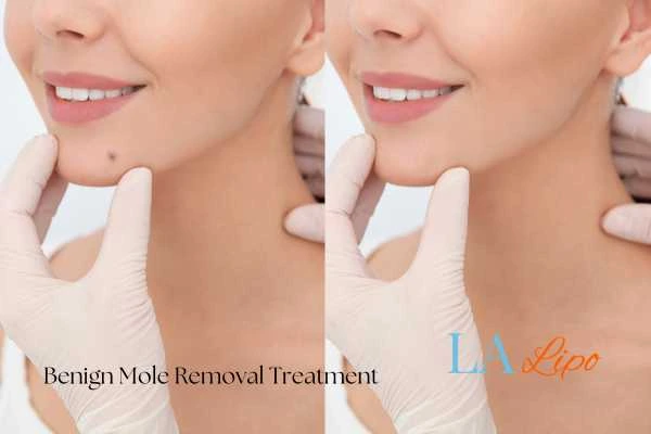 Before-and-after results following benign mole-removal treatment Lower Place