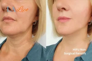 hi-fu for wrinkles Lower Place before and after results