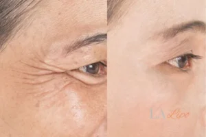 Before and after results of woman - HI-fu wrinkles reduction treatment Lower Place