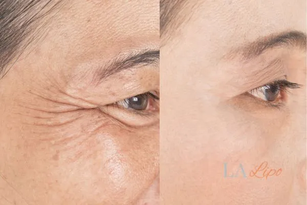 Before and after results of woman - HI-fu wrinkles reduction treatment Lower Place