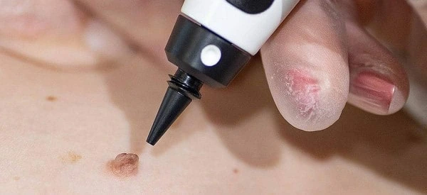 skin tag removal using cryopen Lower Place