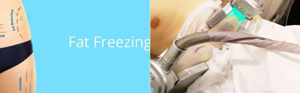 multi areas of a persons body having coolsculpting Lower Place treatment