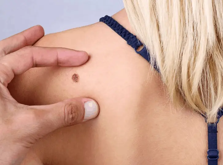 woman having mole removal Lower Place consultation before treatment.