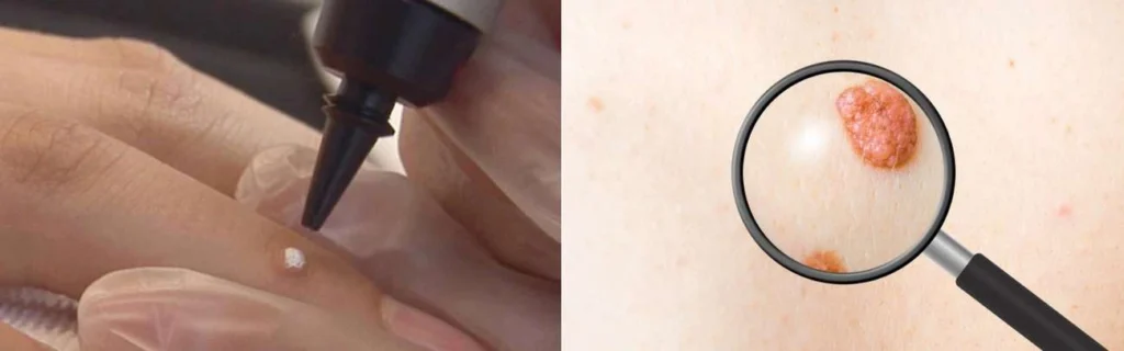CryoPen practitioner Lower Place assessing a benign mole before treatment