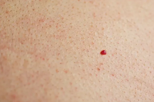 close up of a cherry angioma Lower Place