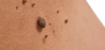 image of a skin tag Lower Place