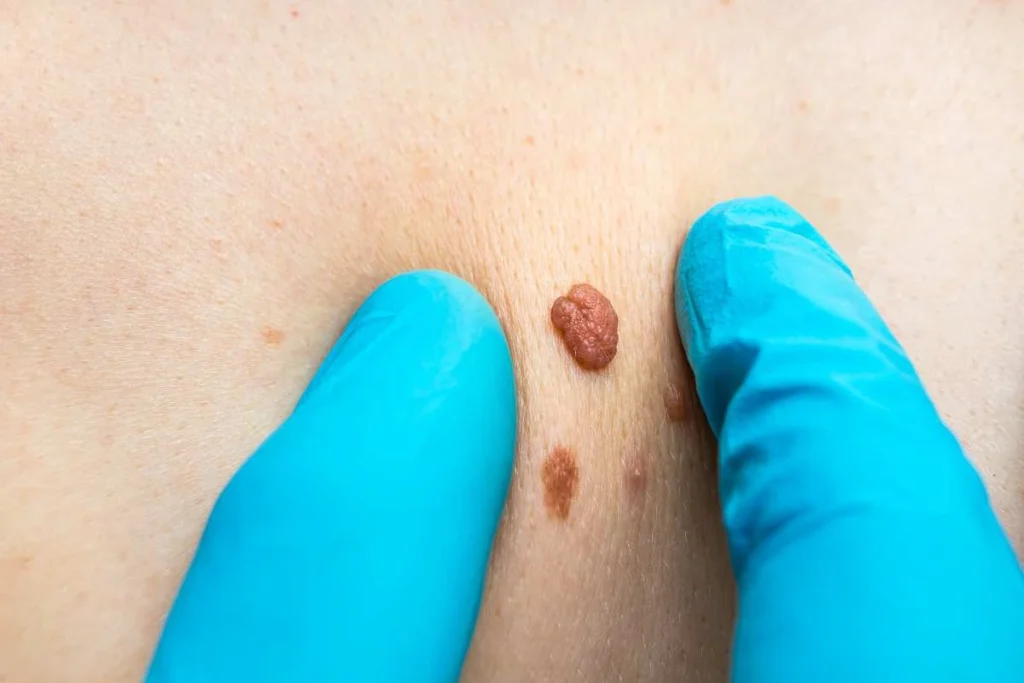 Consultant examining a skin tag Lower Place