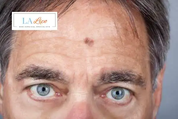 Solar Lentigo Removal Lower Place image of man with mark on his forehead