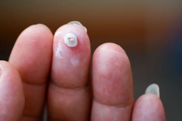wart on person finger - cryotherapy to treat from LA LIPO Lower Place