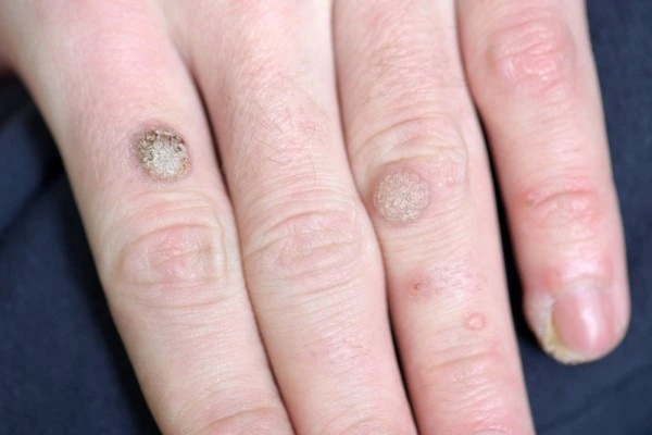 photo of warts on person hand - see wart removal Lower Place from LA LIPO