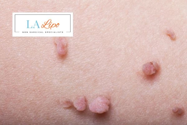 Does cryopen skin tag removal Lower Place hurt? Find out now call our team today!