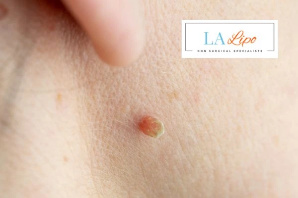 Book skin tag removal Lower Place today speak to our team now!