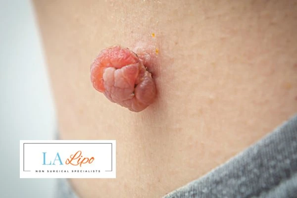 Interested in skin tag removal Lower Place? Concerned about the pain? Find out more today!