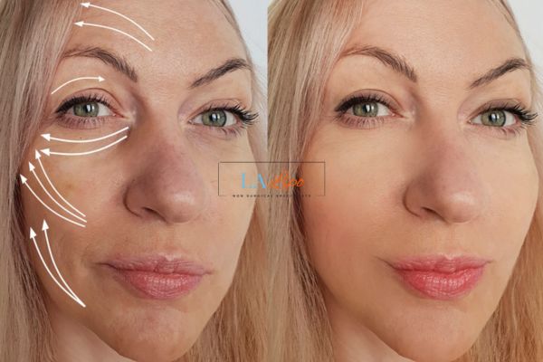 Morpheus 8 results Lower Place face lift.
