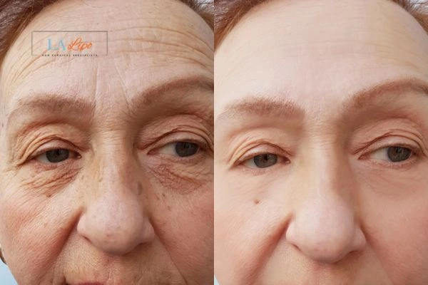 The powerful benefits of Morpheus8 Treatment Lower Place - Call Our team today!