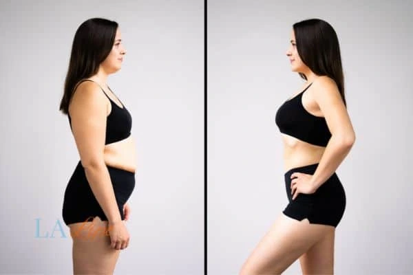 Picture of womans before and after using LA-EMS body sculpting to improve her core strength Lower Place