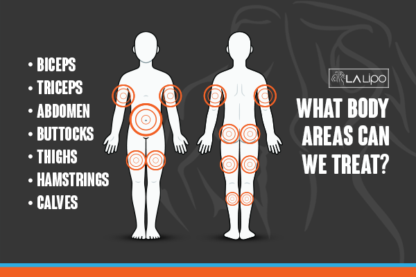 Diagram to show areas you can have LA-EMS Body Sculpting Treatment Lower Place