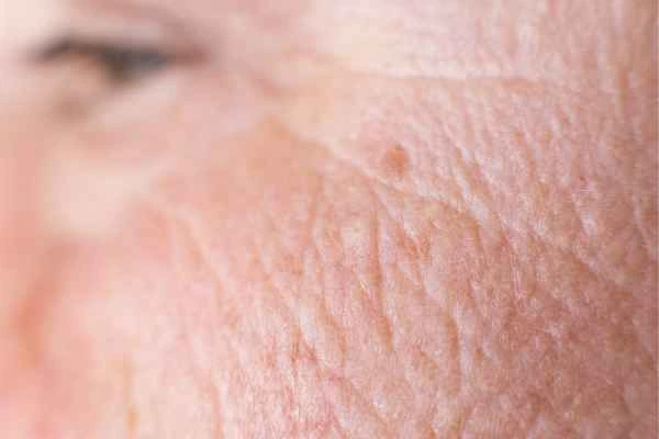 close up picture of a woman's face showing an age spot Lower Place
