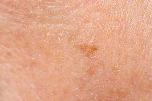 close up picture of age spots Lower Place