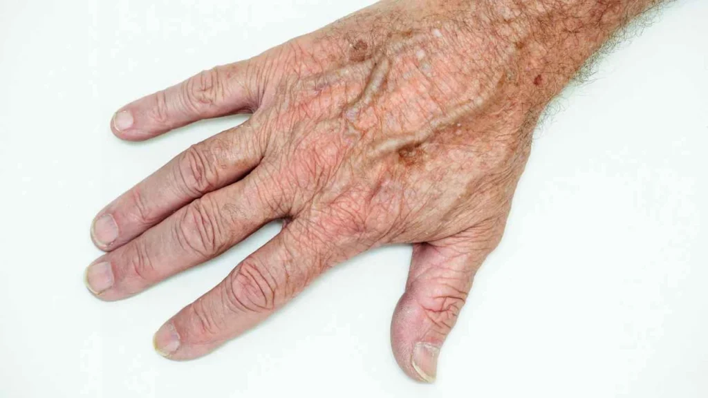 Male hand showing age spot Lower Place