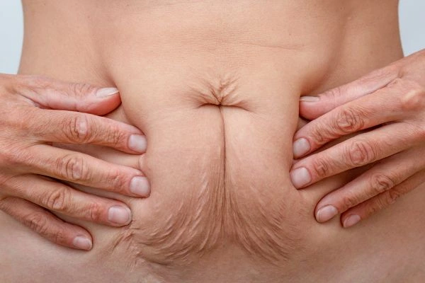 Should I Combine Diastasis Recti Treatment with Body Contouring for Better Results Lower Place?