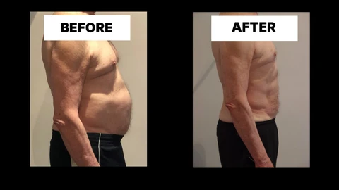 What Symptoms Can Diastasis Recti Cause in Men? Weak Core, Back Pain and Poor Posture Lower Place